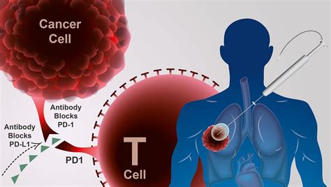 melanoma lung cancer treatment immunotherapy